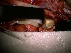 Covering the brain with a sponge to protect the exposed area while surgery continues. The movie shows a lot of digging to remove the dermoid cyst.