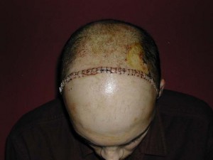 Piercing fanatic? No, just a guy who had a bicoronal incision and now has a lot staples to hold it together. The sore on the right of this picture is where a temporary shunt was installed to mitigate any swelling in the brain. The shunt was gone after a couple days.